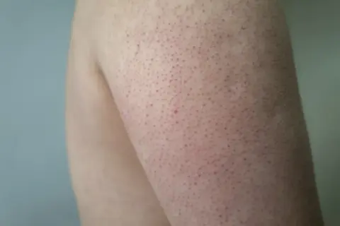 Närbild på arm med keratosis pilaris. Små röda prickar syns över hela huden, vilket kan vara ett tecken på att behandling behövs.
