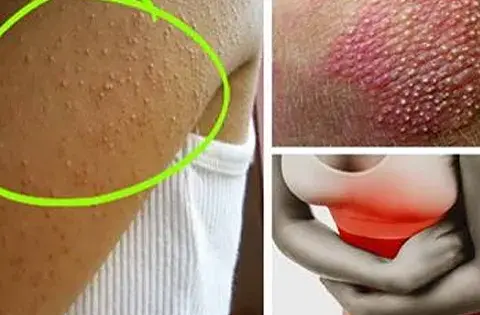 Nietolerancja glutenu i laktozy: objawy, diagnostyka i jak odróżnić
