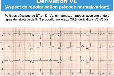 Électrocardiogramme montrant une dérivation VL avec un léger sus-décalage de ST, aspect de repolarisation précoce. L'ECG D2 long révèle une onde J.