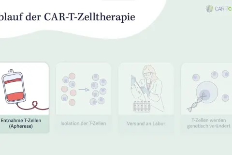 CAR-T-Zelltherapie voraussetzungen: Entnahme, Isolation, Versand ins Labor und genetische Veränderung von T-Zellen.