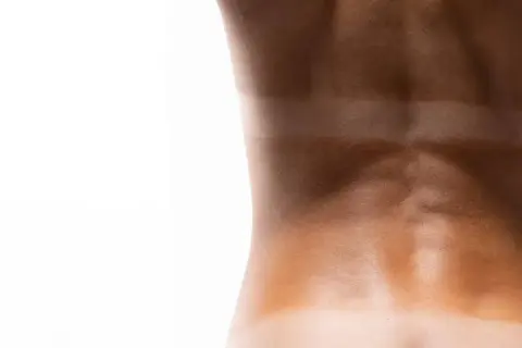 Dos bandes de bronzage distinctes sur le dos, témoignant d'une exposition au soleil ou aux rayons uv b.
