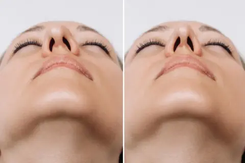 Comparativa de rinomodelación con ácido hialurónico. Mejora sutil de la forma nasal.