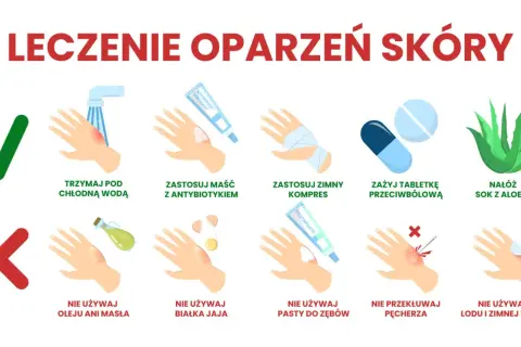 Porady dotyczące leczenia oparzeń skóry: chłodna woda, maść z antybiotykiem, zimny kompres, leki przeciwbólowe, aloes. Unikaj masła, jajka, pasty do zębów, lodu.