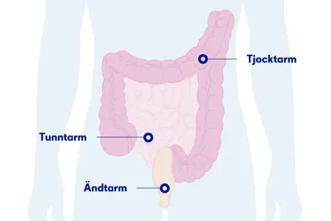 Illustration av tunntarm, tjocktarm och ändtarm. Om du upplever symtom på inflammation i tunntarmen, sök vård.