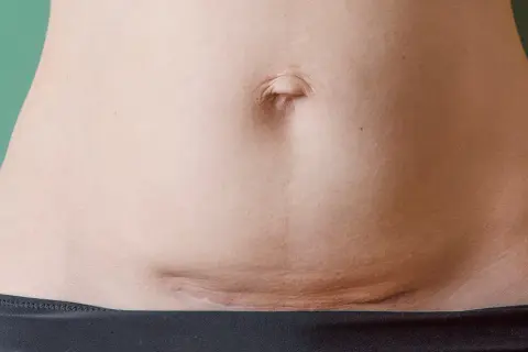Jak wygląda blizna po cesarce? Co warto wiedzieć o jej wyglądzie