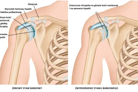 Zdrowy staw barkowy z gładką chrzątką na głowie kości ramiennej i panewce łopatki obok stawu ze zniszczoną chrząstką.