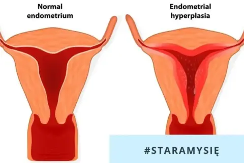 Porównanie prawidłowego endometrium z przerostem. Przerost endometrium może wymagać leczenia.