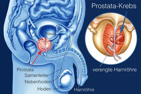 Anatomie der männlichen Beckenorgane mit Fokus auf Prostatakrebs. Ein vergrößerter Ausschnitt zeigt Tumore in der Prostata, die die Harnröhre verengen. Mögliche Prostatakrebs-Metastasen sind angedeutet.