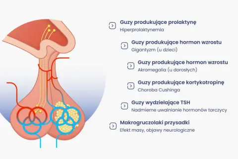 Ilustracja przedstawia przysadkę mózgową i różne guzy, które mogą wpływać na jej funkcjonowanie, powodując objawy takie jak gigantyzm czy akromegalia.