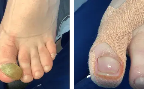 Twarde paznokcie u stóp? Skuteczne domowe sposoby i porady podologa