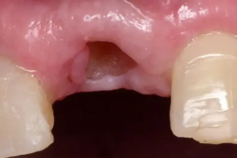 Gingiva con espacio desdentado y dientes adyacentes. Se observa la necesidad de limar diente astillado para mejorar la estética y función.
