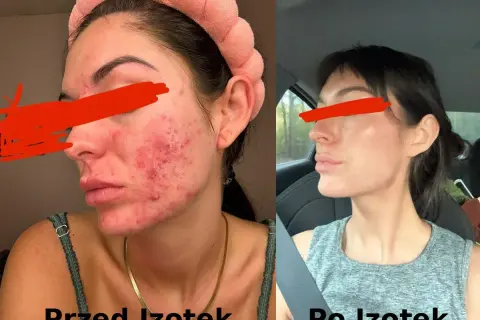 Przed i po leczeniu izotekiem: skóra z trądzikiem i zaczerwienieniem przechodzi transformację w gładką i czystą cerę.
