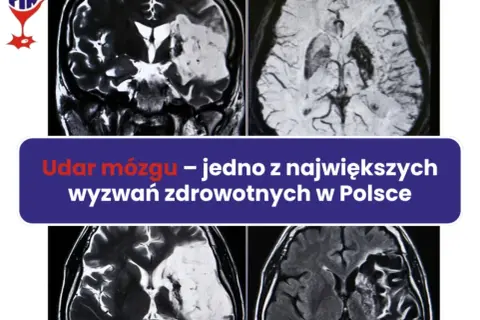 Udar mózgu: Czy umiera się? Kluczowe fakty i nadzieja na życie.