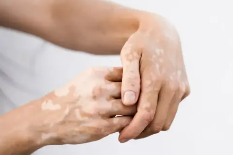 Dłonie z widocznymi plamami bielactwa (vitiligo), tworzącymi unikalny wzór na skórze.