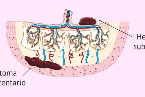 Ilustración de hematoma subcoriónico y retroplacentario, mostrando cómo se expulsa un hematoma en el embarazo.