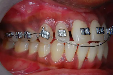 Primo piano di denti con apparecchio fisso. Impossibile togliere l'apparecchio fisso da soli.