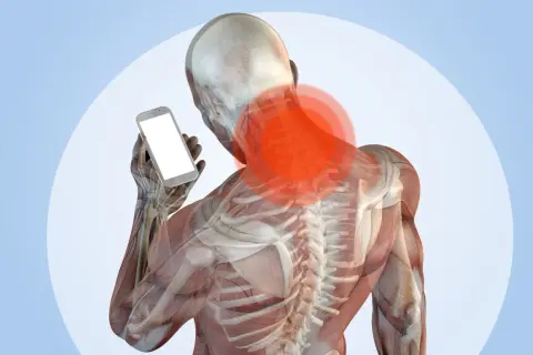 Anatomia del collo con aree rosse di dolore, che illustra il problema del "tech neck" causato dall'uso dello smartphone.