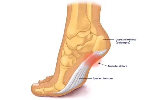 Illustrazione anatomica del piede che evidenzia l'osso del tallone, la fascia plantare e l'area del dolore, utile per capire i tallonite rimedi.
