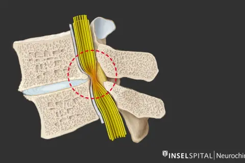Darstellung einer Spinalkanalstenose, die den Nervenstrang komprimiert. Mögliche Indikation für eine spinalkanalstenose op.