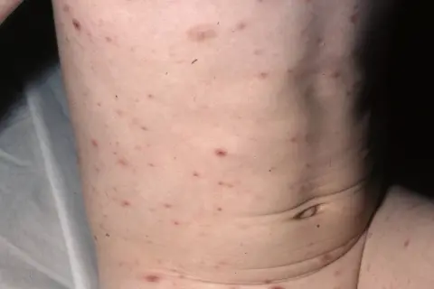 Barnets hud täckt av röda prickar, typiska för vattkoppor.