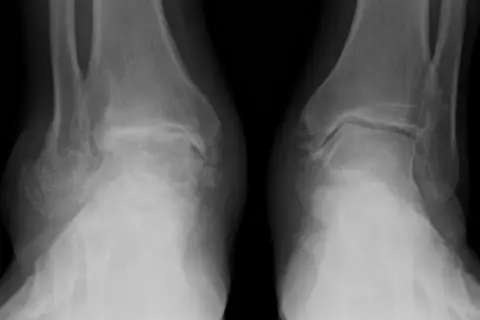 Radiografie delle caviglie mostrano segni di condropatia, con alterazioni articolari evidenti.