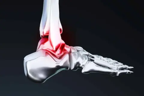 Illustration 3D d'une cheville, montrant la zone rouge de douleur et d'inflammation, essentielle pour la proprioception cheville.