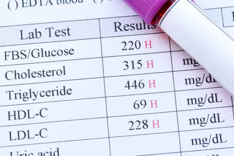 Résultats d'une prise de sang montrant des taux élevés de glucose, cholestérol et triglycérides. Une prise de sang sert à évaluer votre état de santé.