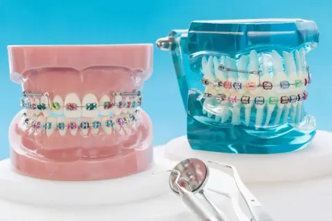 Modelli di denti con apparecchi ortodontici e elastici colorati. Strumenti dentistici in primo piano.