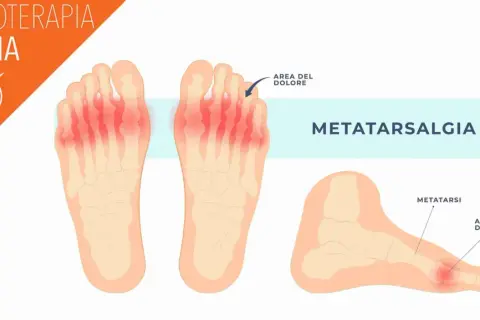 Illustrazione anatomica che mostra la metatarsalgia, un'area di dolore ai metatarsi delle dita dei piedi, evidenziata in rosso.