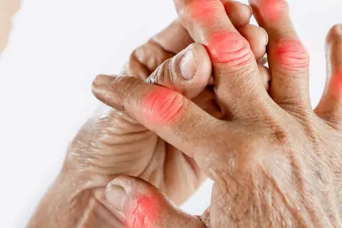 Schmerzende Fingergelenke, die auf Gicht hindeuten. Naturheilkunde kann Linderung bringen.