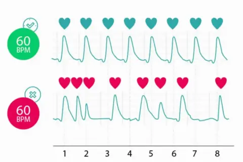 Dwa wykresy EKG: górny z zielonym znacznikiem i 60 BPM, dolny z czerwonym i 60 BPM. Górny pokazuje regularne, zdrowe bicie serca, dolny nieregularne, sugerujące wysokie tętno.