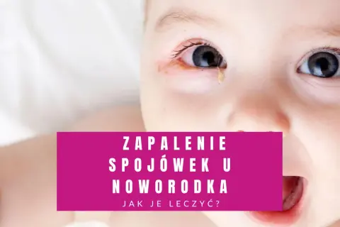 Co na zapalenie spojówek u niemowlaka - objawy, leczenie i profilaktyka