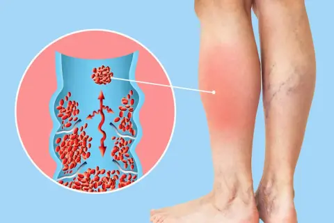 Illustration zeigt ein Bein mit Rötung und Schwellung, verbunden mit einer Veranschaulichung eines Blutgerinnsels in einer Vene. Verdacht auf Thrombose.