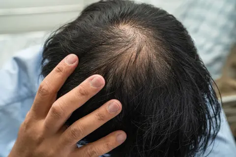 Vue rapprochée du sommet de la tête d'un homme montrant une calvitie naissante. La main d'un homme touche son cuir chevelu, peut-être en réfléchissant à la cause de sa calvitie.