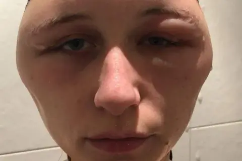 Alergia na farby do włosów objawy - jak uniknąć niebezpiecznych reakcji