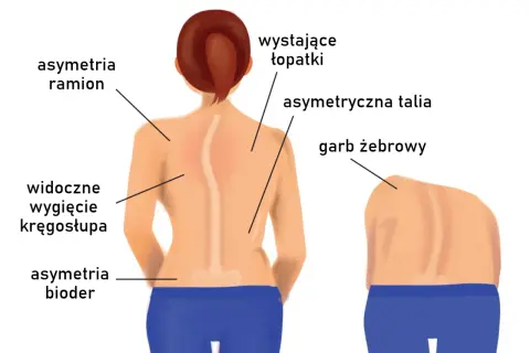 Skolioza u dorosłych objawy: Jak rozpoznać i uniknąć powikłań