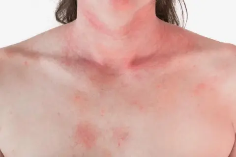 Alergia na truskawki: objawy, reakcje krzyżowe i co robić