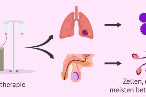 Chemotherapie kann die Fruchtbarkeit nach Chemotherapie Mann beeinträchtigen. Die Grafik zeigt Lungen- und Hodenkrebszellen, die durch die Behandlung angegriffen werden.