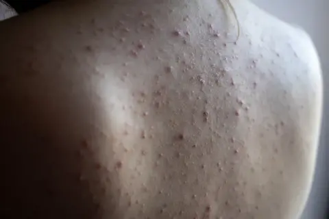 Gros plan sur le dos d'une personne présentant une acné du dos, avec de nombreux petits boutons rouges et blancs sur la peau.
