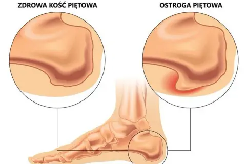 Ból pięty? Leki na zapalenie powięzi podeszwy od apteki po blokadę