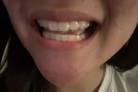 Primo piano di una bocca con apparecchi invisibili e chewies Invisalign per un sorriso perfetto.