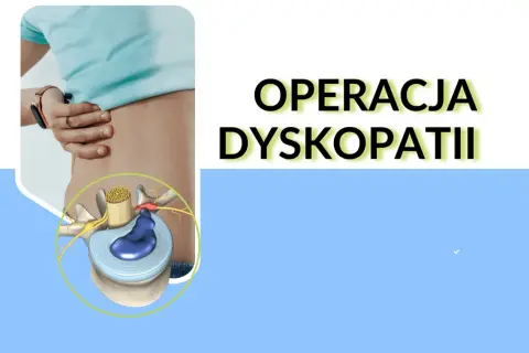 Operacja dyskopatii: ilustracja krążka międzykręgowego i nerwu. Dowiedz się, dyskopatia co to jest.