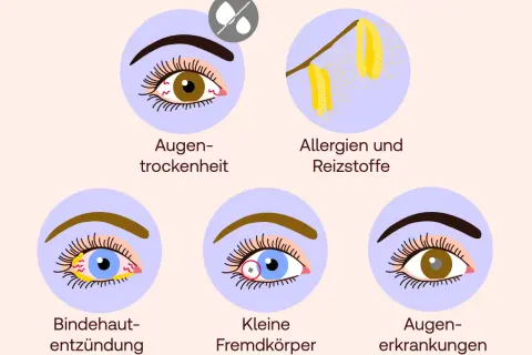 Illustrationen zeigen Ursachen für brennende Augen: Trockenheit, Allergene, Bindehautentzündung, Fremdkörper und allgemeine Augenerkrankungen.