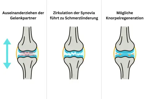 Illustration zeigt Knie-Distraktion: Gelenkpartner ziehen auseinander, Synovia-Zirkulation lindert Schmerz, Knorpel kann sich regenerieren.