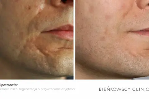 Przed i po lipofilling twarzy: widoczna poprawa blizn i przywrócenie objętości skóry.