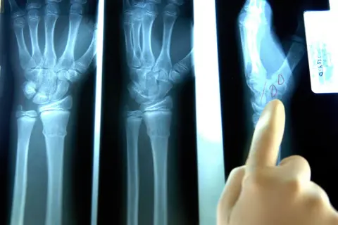 Radiografie del polso mostrano una mano con possibile distorsione al polso. Un dito indica un'area di interesse.