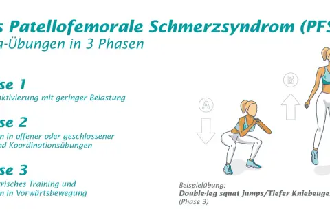 Reha-Übungen in 3 Phasen für das Patellofemorale Schmerzsyndrom (PFSS). Illustration zeigt eine Frau bei Kniebeugen und Sprüngen.