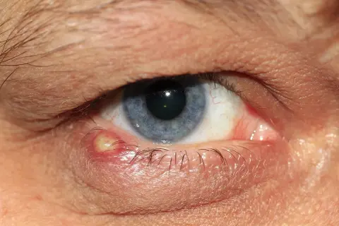 Ein entzündeter Gerstenkorn am Augenlid, der Juckreiz verursacht. Das Auge ist rot und geschwollen.