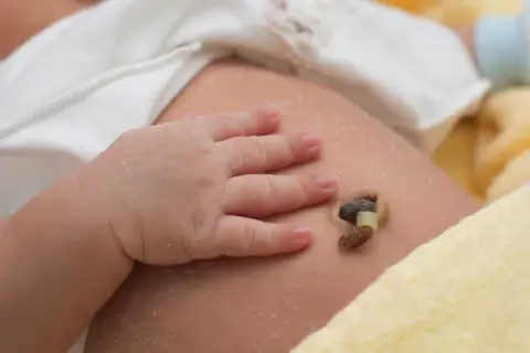 Babybauch mit abgefallener Nabelschnur und leichter Kruste. Ein kleines Babyhändchen liegt daneben.