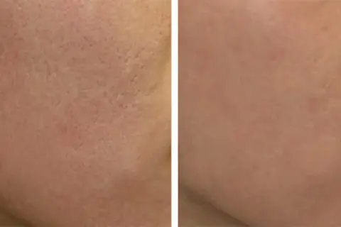 Peeling węglowy co daje? Efekty, korzyści i przeciwwskazania dla zdrowej skóry